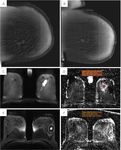 Breast cancer in dense breasts: comparative diagnostic merits of contrast-enhanced mammography and diffusion-weighted breast MRI - Egyptian ...