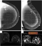 Breast cancer in dense breasts: comparative diagnostic merits of contrast-enhanced mammography and diffusion-weighted breast MRI - Egyptian ...