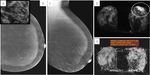 Breast cancer in dense breasts: comparative diagnostic merits of contrast-enhanced mammography and diffusion-weighted breast MRI - Egyptian ...