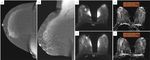 Breast cancer in dense breasts: comparative diagnostic merits of contrast-enhanced mammography and diffusion-weighted breast MRI - Egyptian ...