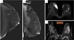 Breast cancer in dense breasts: comparative diagnostic merits of contrast-enhanced mammography and diffusion-weighted breast MRI - Egyptian ...