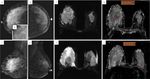Breast cancer in dense breasts: comparative diagnostic merits of contrast-enhanced mammography and diffusion-weighted breast MRI - Egyptian ...