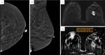 Breast cancer in dense breasts: comparative diagnostic merits of contrast-enhanced mammography and diffusion-weighted breast MRI - Egyptian ...