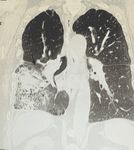 Atypical Legionnaires' Disease in the Setting of Suspected Recurrent Lung Cancer - Cureus
