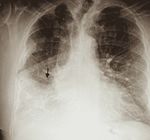 Atypical Legionnaires' Disease in the Setting of Suspected Recurrent Lung Cancer - Cureus
