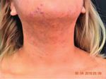 Case Series Topical Treatment of Truncal Acne with Tretinoin Lotion 0.05% and Azelaic Acid Foam - Hindawi.com