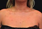 Case Series Topical Treatment of Truncal Acne with Tretinoin Lotion 0.05% and Azelaic Acid Foam - Hindawi.com