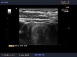 THYROID METASTASIS OF A SQUAMOUS CELL CARCINOMA OF THE TONGUE - A RARE CASE REPORT