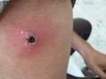 Spider Bites in Libya - Asian Journal of Research in ...