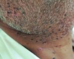 Efficacy of Topical 5% 5-Fluorouracil and 0.05% Tretinoin and Electrosurgery in the Treatment of Plane Warts: A Randomized Controlled Comparative ...