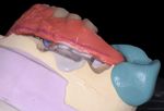 Case Report Using the "One Shot" Concept for Immediate Loading Implant Protocol in Edentulous Patient Rehabilitation with a Fixed Prosthesis: A ...