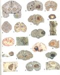 An Introduction to Brain Tumours and Neuroanatomy - Dr. Ruman Rahman Assistant Professor of Molecular Neuro-Oncology - Introduction to brain ...