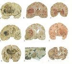 An Introduction to Brain Tumours and Neuroanatomy - Dr. Ruman Rahman Assistant Professor of Molecular Neuro-Oncology - Introduction to brain ...