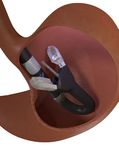 Endoscopic Management of Gastroesophageal Reflux Disease: Revisited