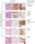 The Evolution of Ovarian Carcinoma Subclassification - MDPI