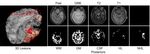 A Patient-Specific Segmentation Framework for Longitudinal MR Images of Traumatic Brain Injury