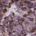A DLL3-targeted antibody-drug conjugate eradicates high-grade pulmonary neuroendocrine tumor-initiating cells in vivo - Science Translational Medicine