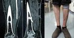 Application of Intelligent Computer-Assisted Taylor 3D External Fixation in the Treatment of Tibiofibular Fracture: Retrospective Case Study ...