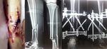 Application of Intelligent Computer-Assisted Taylor 3D External Fixation in the Treatment of Tibiofibular Fracture: Retrospective Case Study ...