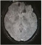 Cerebral fat embolism syndrome after long bone fracture due to traffic accident: a case report