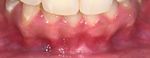 Case Report A Successful Esthetic Approach of Gingival Depigmentation Using Microneedling Technique and Ascorbic Acid (Vitamin C) - Hindawi.com