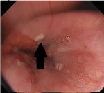 The Outcome of Endoscopic Radiofrequency Anti-Reflux Therapy (STRETTA) for Gastroesophageal Reflux Disease in Patients with Previous Gastric ...