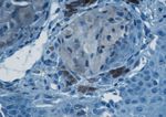 Spitz nevus with an uncertain malignant potential
