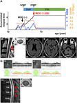 Case Report: Anti-MOG Antibody Seroconversion Accompanied by Dimethyl Fumarate Treatment - Frontiers