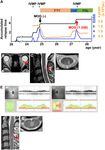 Case Report: Anti-MOG Antibody Seroconversion Accompanied by Dimethyl Fumarate Treatment - Frontiers