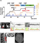 Case Report: Anti-MOG Antibody Seroconversion Accompanied by Dimethyl Fumarate Treatment - Frontiers