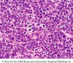 Hodgkin's Lymphoma Dr. Geetika Vohra Department of Pathology