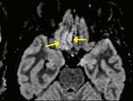 MRI Depicts Olfactory Bulbs and Cortical Involvement in COVID-19 Patients with Anosmia