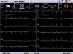 ARGUS PRO LifeCare 2 Defibrillator, pacemaker, patient monitor and 12-channel ECG in a compact design