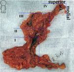Minimize the extent and morbidity of axillary dissection for node-positive breast cancer patients: implementation of axillary lymph node ...