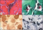 HIV-associated neuromuscular weakness syndrome