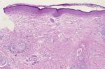 Cutaneous and Pulmonary Sarcoidosis in Association With Tattoos