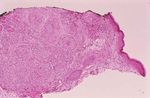Cutaneous and Pulmonary Sarcoidosis in Association With Tattoos