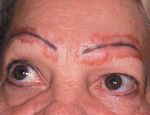 Cutaneous and Pulmonary Sarcoidosis in Association With Tattoos
