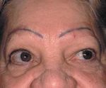 Cutaneous and Pulmonary Sarcoidosis in Association With Tattoos