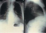Cutaneous and Pulmonary Sarcoidosis in Association With Tattoos