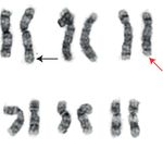 Case Report Concurrent Central Diabetes Insipidus and Acute Myeloid Leukemia - Hindawi.com