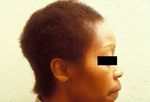 Approach to Hair Loss in Women of Color - Jennifer M. Fu, MD, and Vera H. Price, MD, FRCP(C)