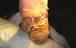 Ultrasonic Surgical Debridement - Controlled tissue removal Decreased healing times1 Reduced bleeding2 Reduction of biofilm3-5