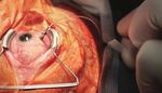 The Benefits of Trocar-Based Chandelier Vitreoretinal Surgery