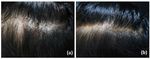 308-nm Excimer Lamp vs. Combination of 308-nm Excimer Lamp and 10% Liquor Carbonis Detergens in Patients With Scalp Psoriasis: A Randomized ...