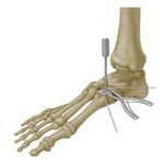 Symalign Allograft Wedge System - Surgical Technique Overview Allograft Osteotomy Wedges - J&J Medical Devices