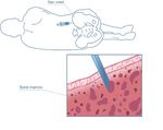 Myelodysplastic Syndromes (MDS) - A Guide for Patients - Leukaemia Care