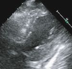Case Report Permanent Pacemaker Implantation in a Patient with Takotsubo Cardiomyopathy and Complete Atrioventricular Block