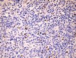 Primary Thyroid Lymphoma in a Patient with Hashimoto Disease