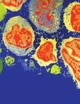 Case Report Tuberculosis of the Thyroid Gland Presented as a Rapid Enlargement of a Preexisting Goiter